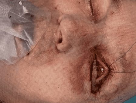 Close-up of a person's swollen face.