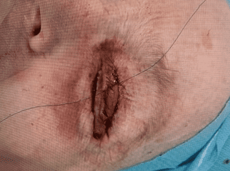 Surgical wound with stitches on skin.