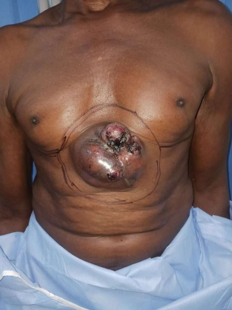 Large chest tumor close-up on patient.