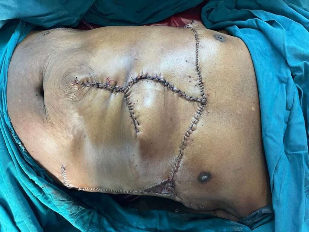 Surgical stitches on abdominal area with blue drapes.