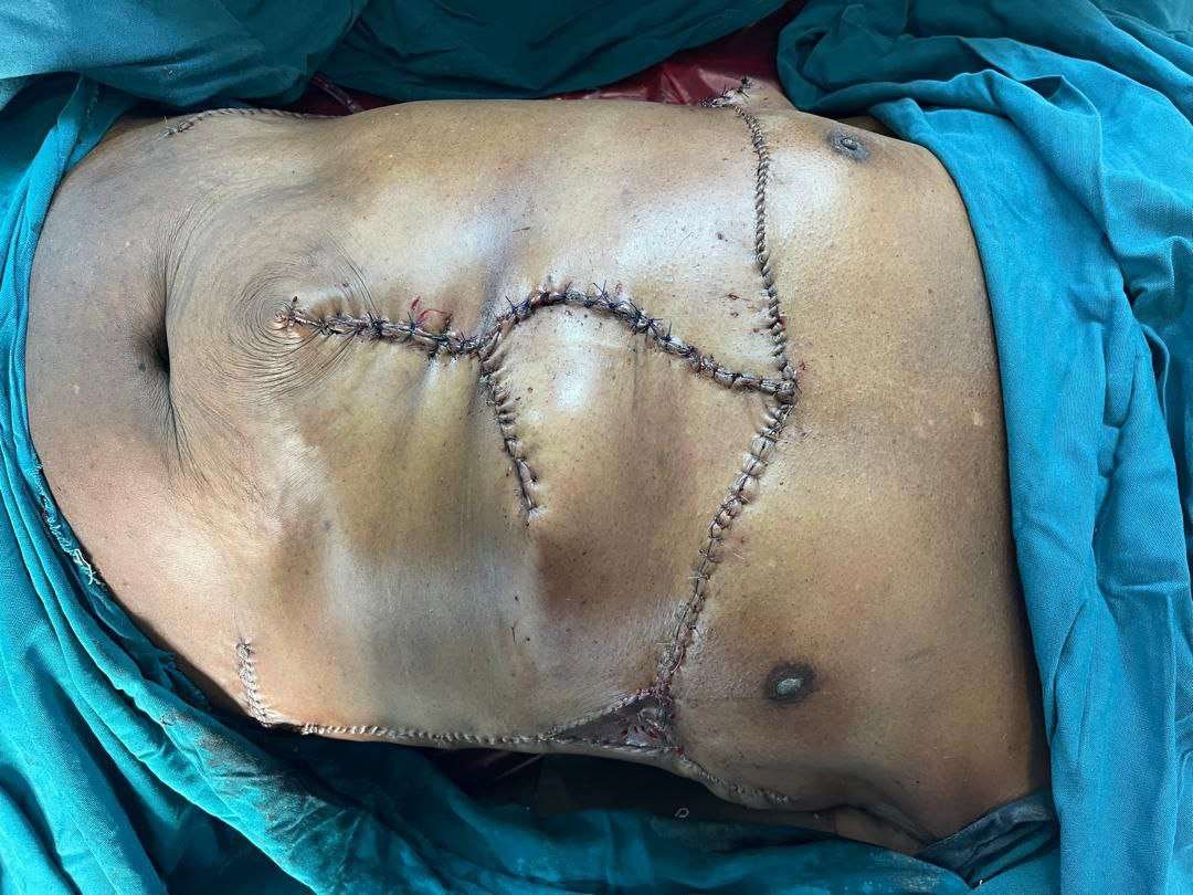 Surgical stitches on abdominal area with blue drapes.