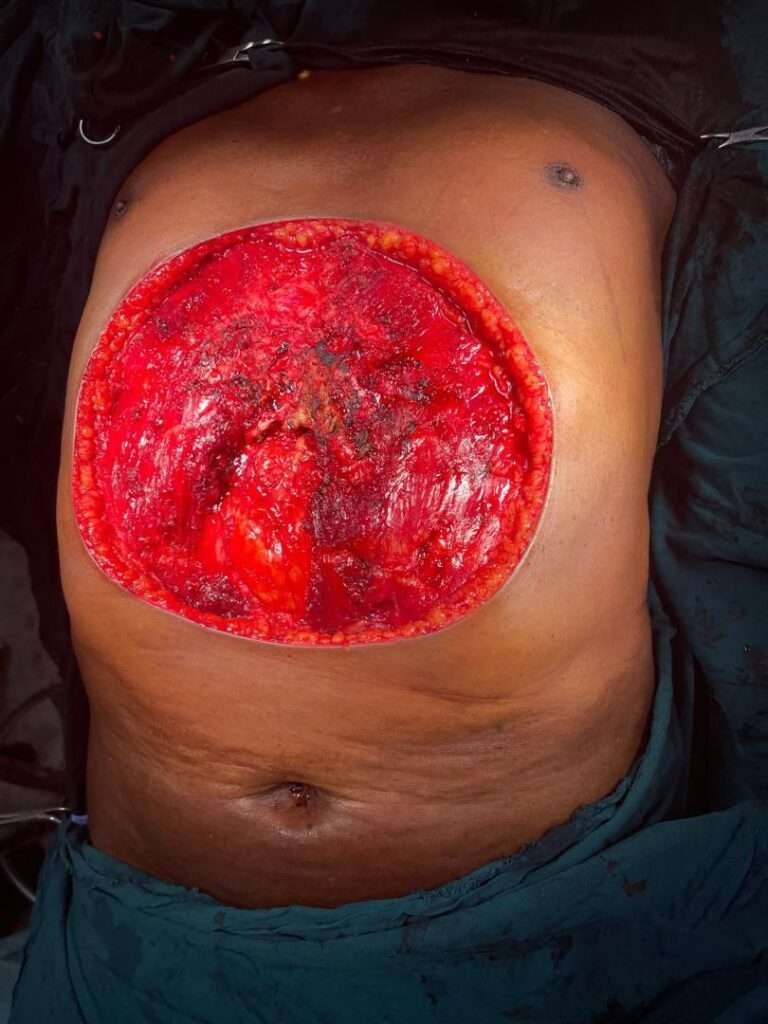 Surgical wound on abdomen