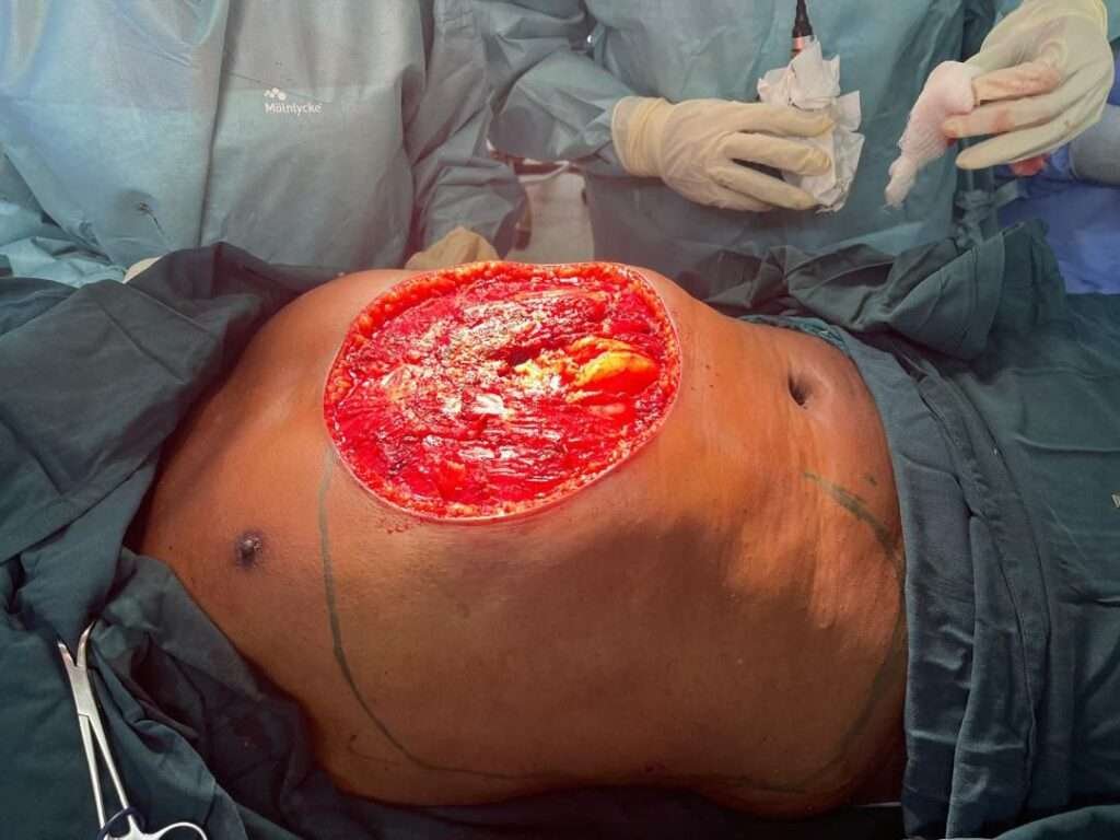 Surgical procedure on exposed abdominal area.