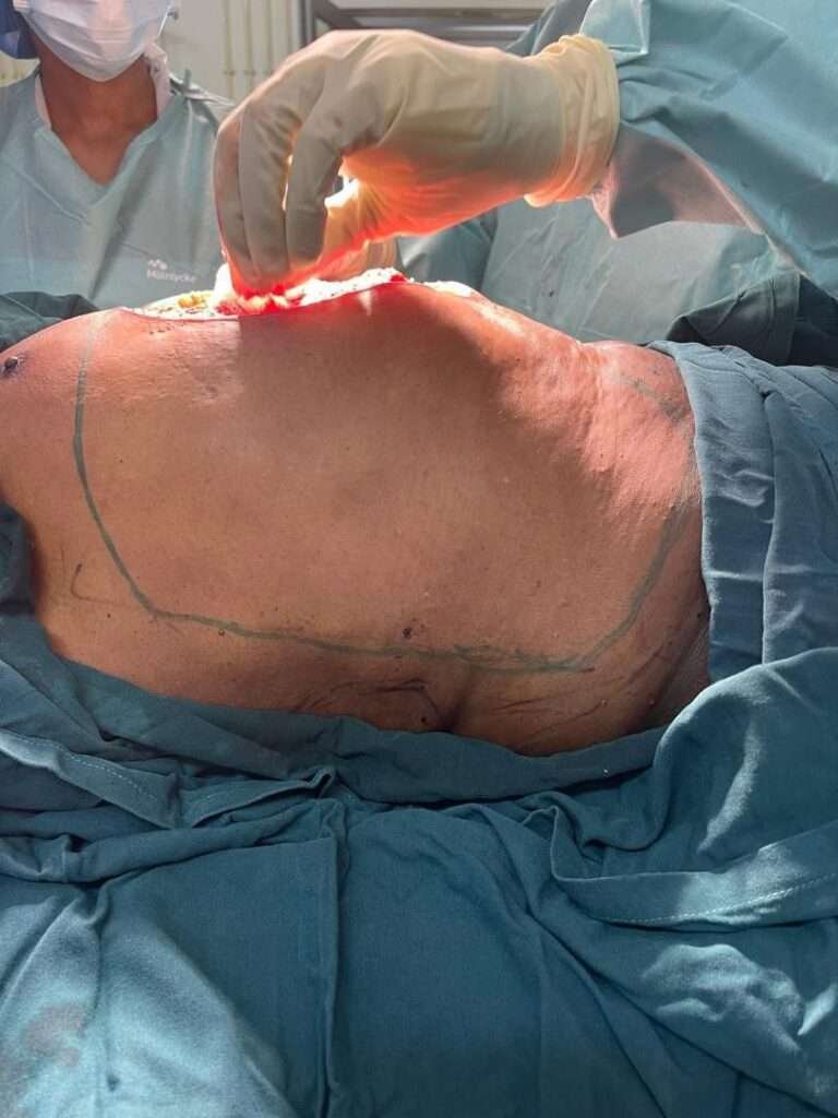 Surgeon performing chest incision in operating room.