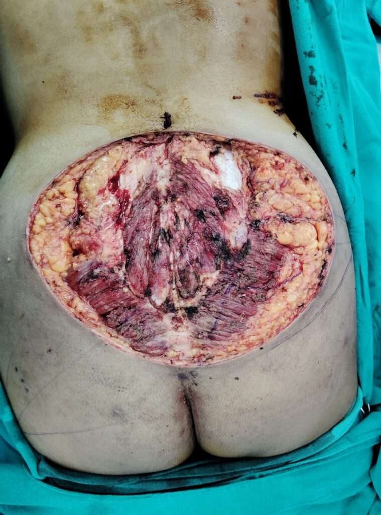 Surgical wound on lower back post-debridement