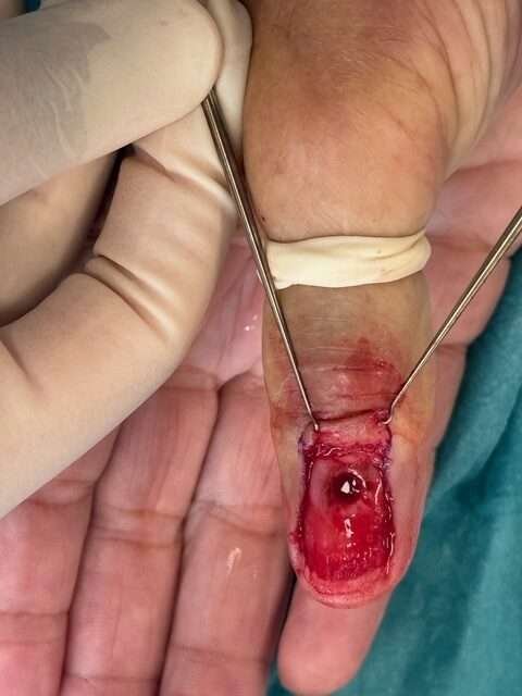 Surgical procedure on an injured finger