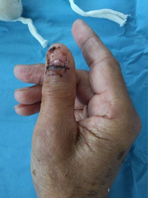 Injured thumb with stitches