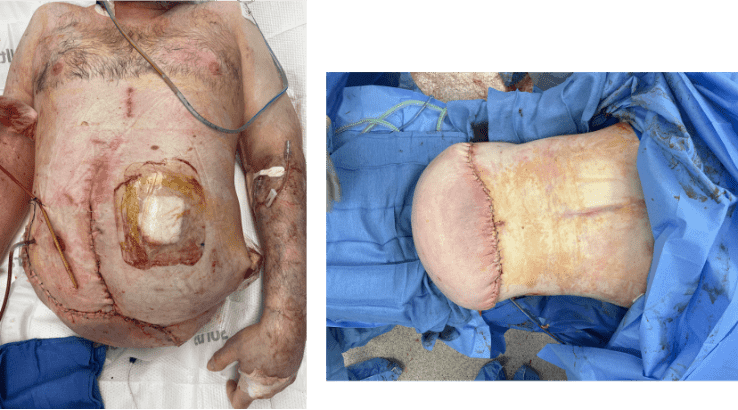 Post-surgery abdominal view and removed tissue.