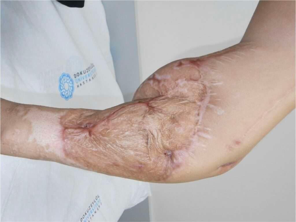 Close-up of scarred human arm