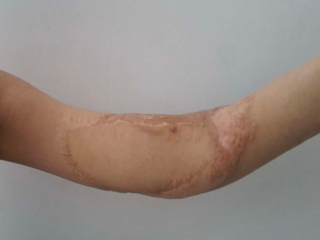 Arm with extensive burn scars
