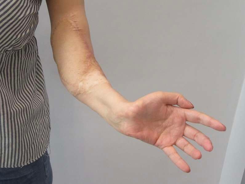 postop after debulking 2