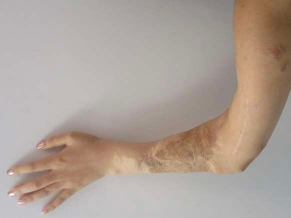 Arm with burn scars and discoloration