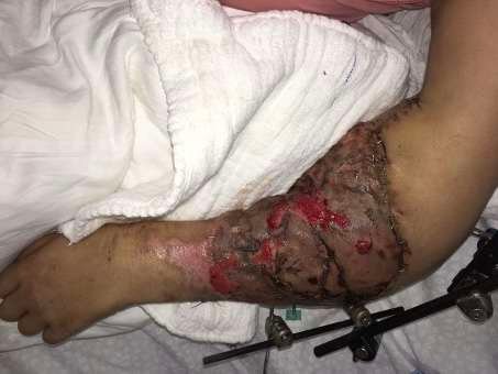 Injured arm with medical hardware.