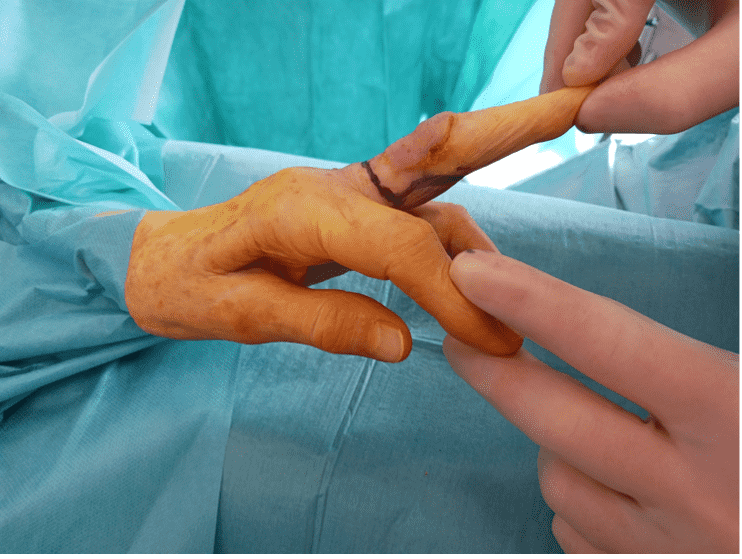 Surgical preparation on a finger with gloves