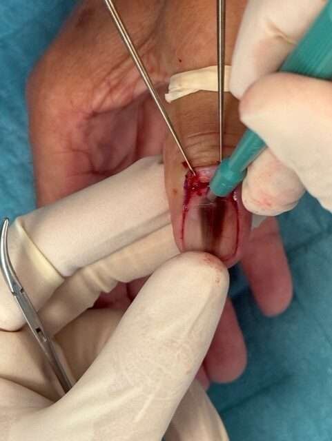 Close-up of a surgical procedure on a finger