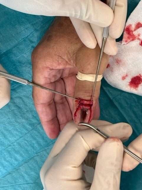 Surgical procedure on a finger.