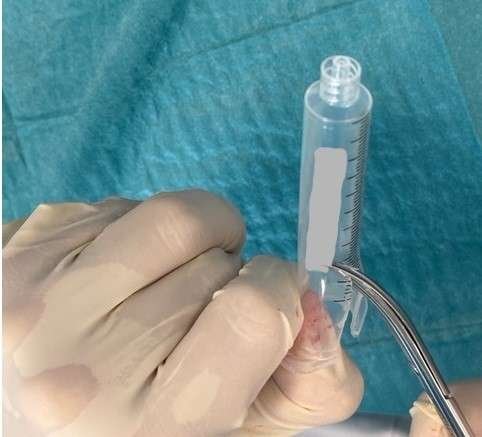 Hand holding a syringe and using forceps.
