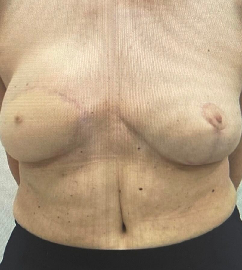 Post-surgery torso showing scars and moles.