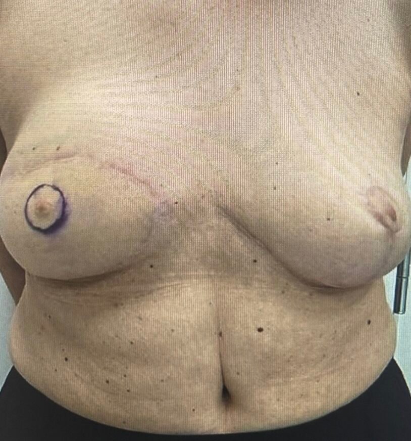 Post-surgery breast scarring with markings