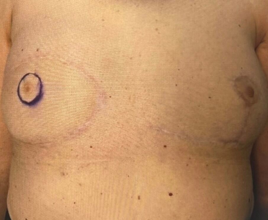 Chest with surgical markings and scars.