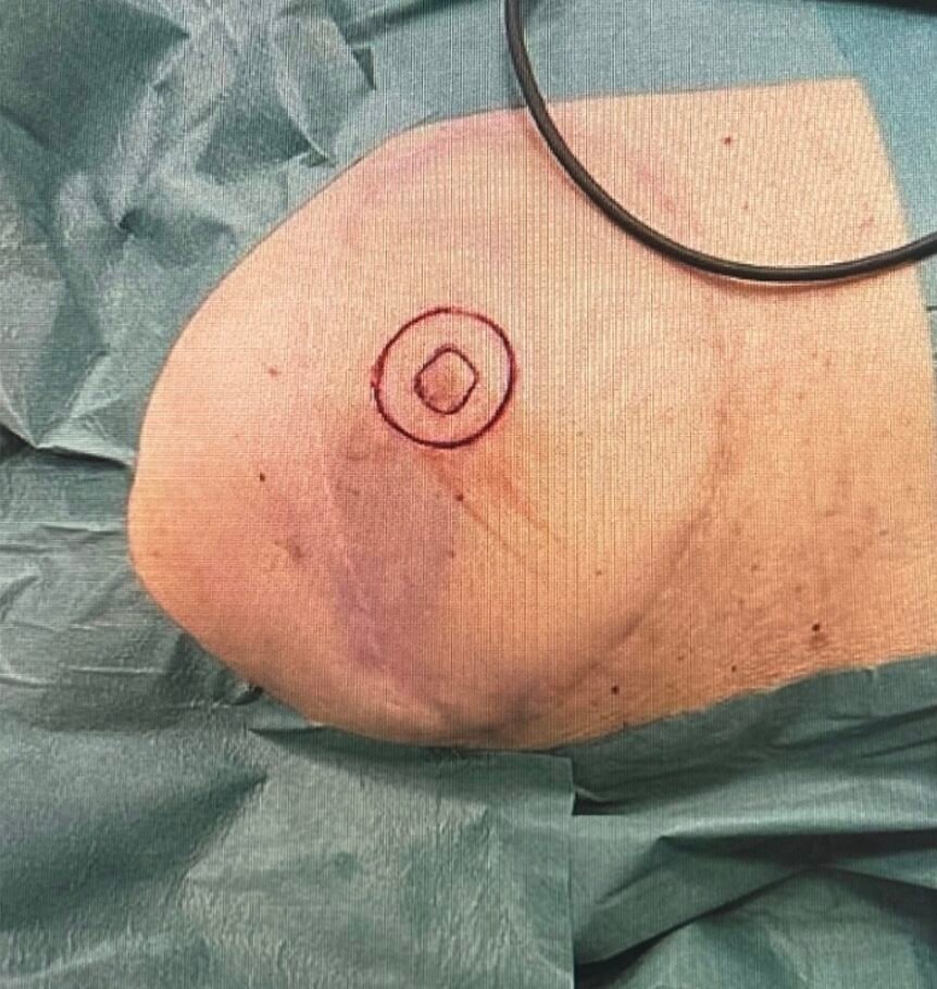 Arm with surgical marking