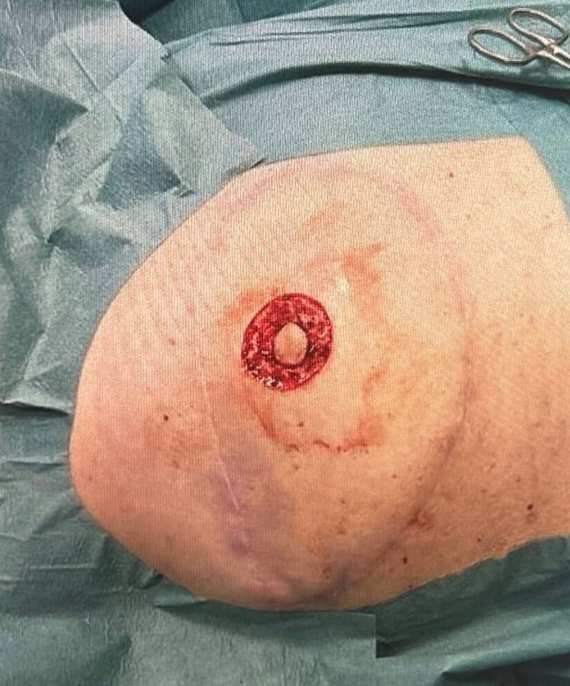 Surgical procedure on upper arm