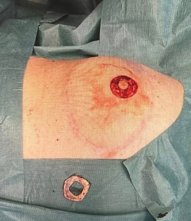 Surgical view with gauze and skin marking