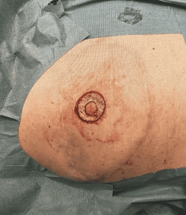 Surgical procedure on a breast