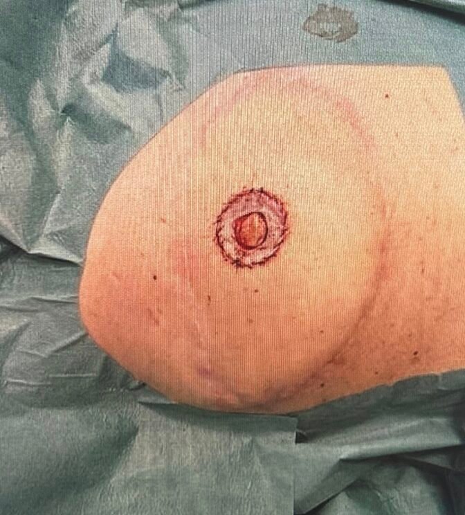 Surgical marking around breast incision