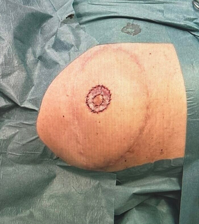Surgical site on covered patient arm.
