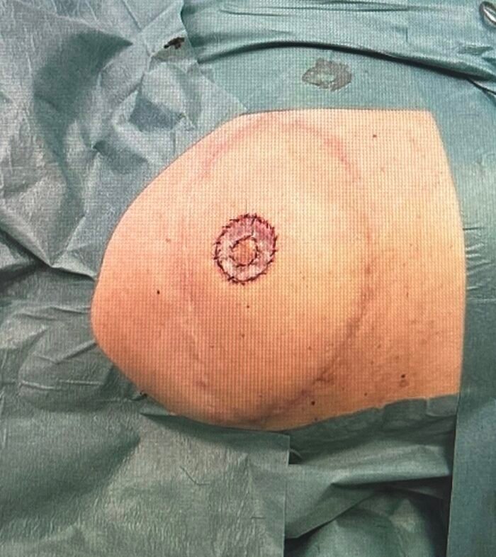 Surgical site on covered patient