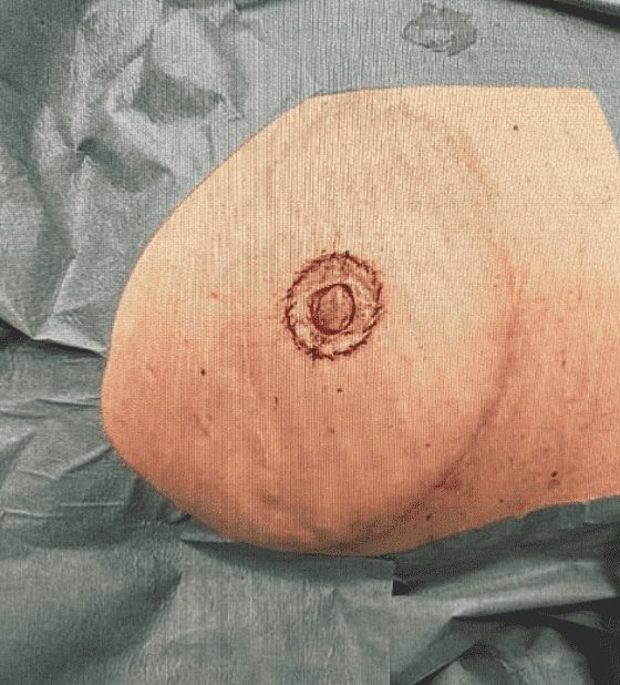 Close-up of a skin lesion excision