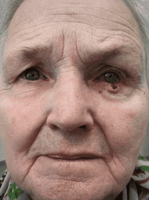 Close-up of elderly woman with eye condition.