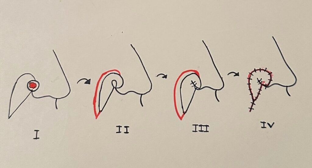 Illustration of surgical procedure on the nose