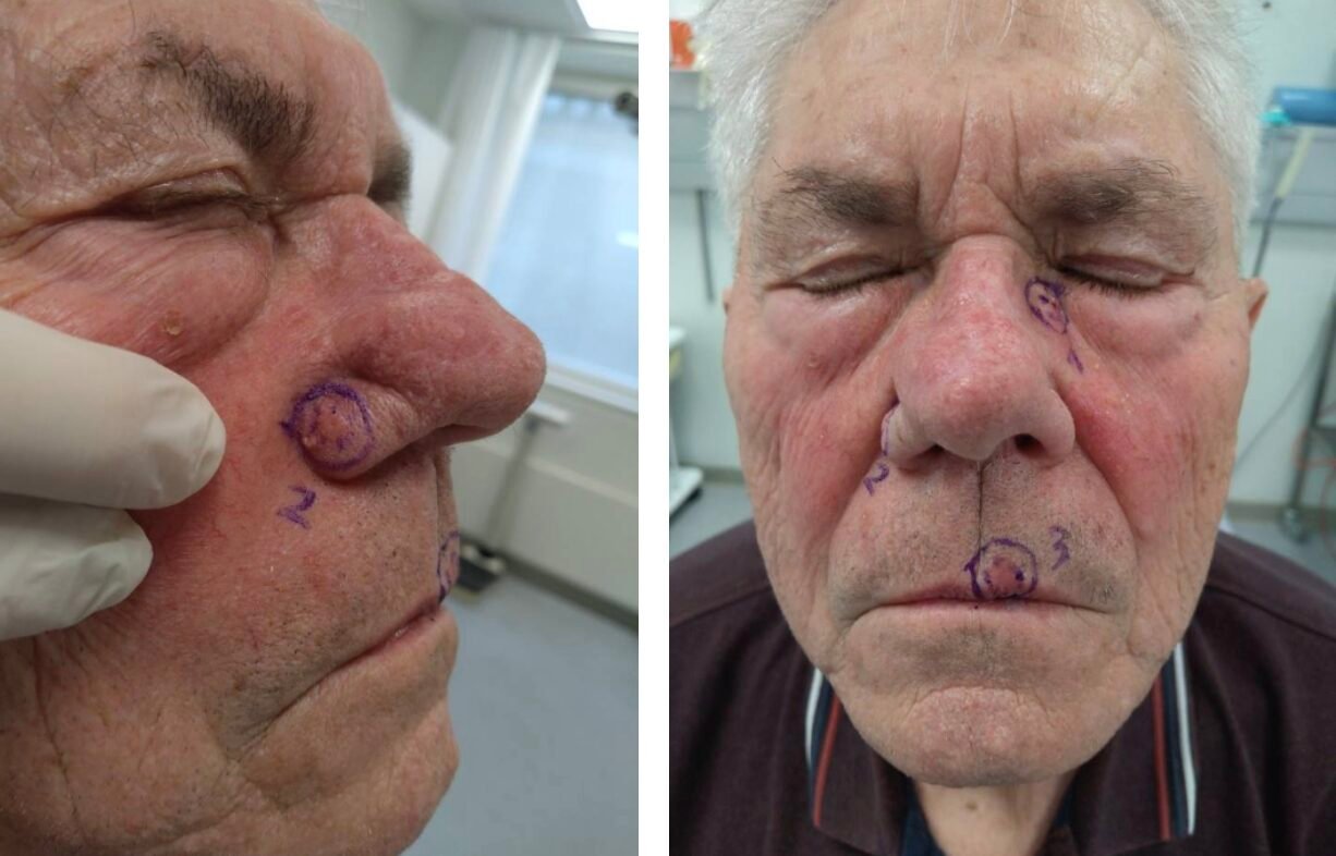 Two images of a man's face with markings