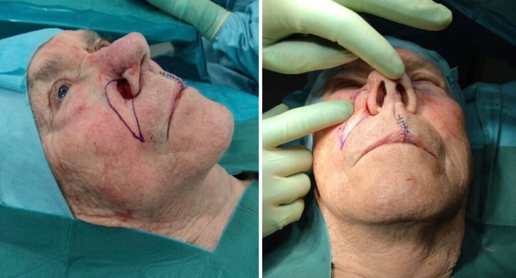 Nasal reconstruction surgery on an elderly patient.