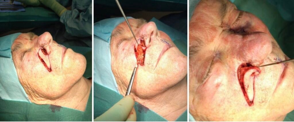 Surgical procedure on facial skin
