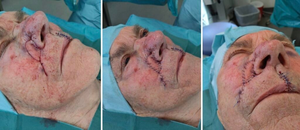 Post-surgery stitches on a patient's face