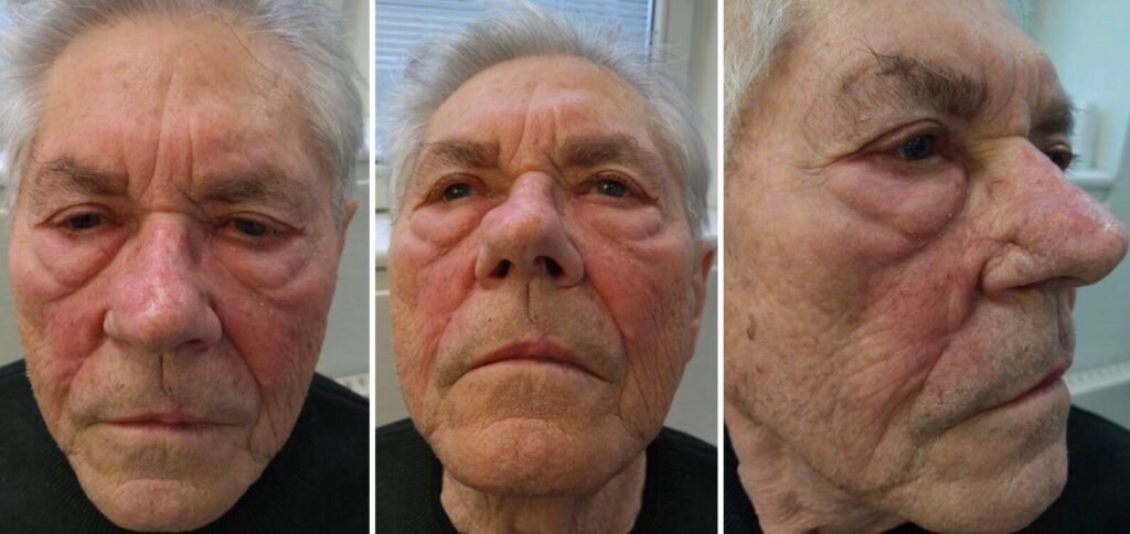 Elderly man with facial swelling