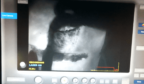 Infrared imaging on a monitor screen.