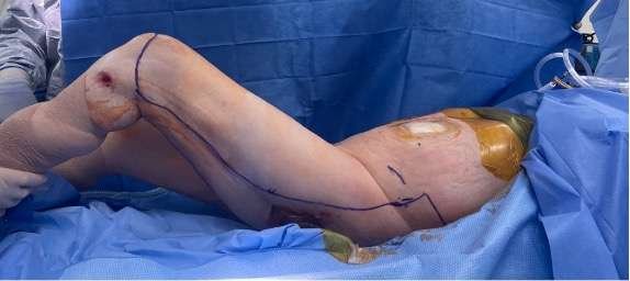 Leg prepared for surgical procedure