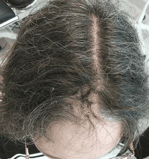 Close-up of scalp with hair and crusted area