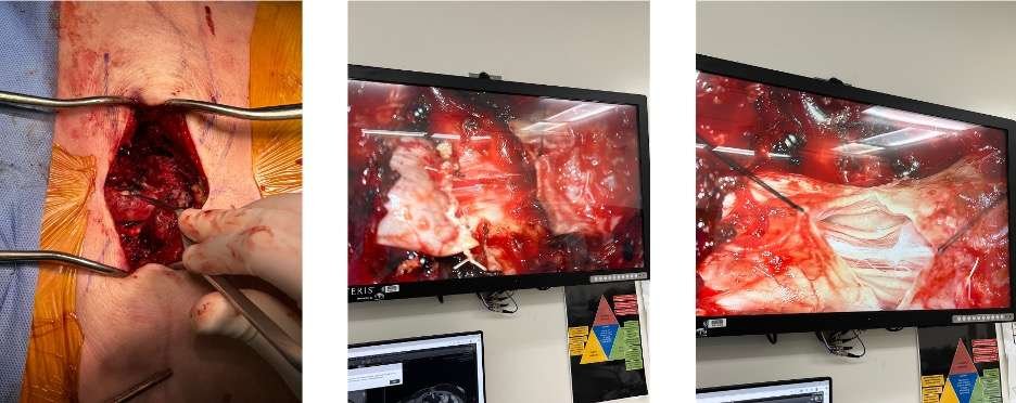 Surgical procedure with screen displays