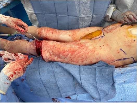 Surgical procedure on an amputated leg