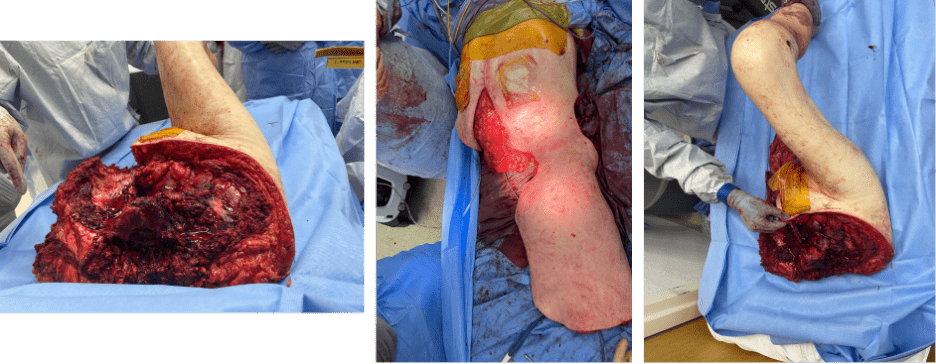 Surgical amputation procedure on a patient's leg.