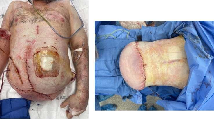 Post-surgical abdominal procedure
