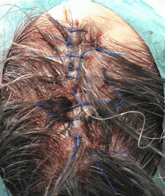 Surgical stitches on a scalp wound.