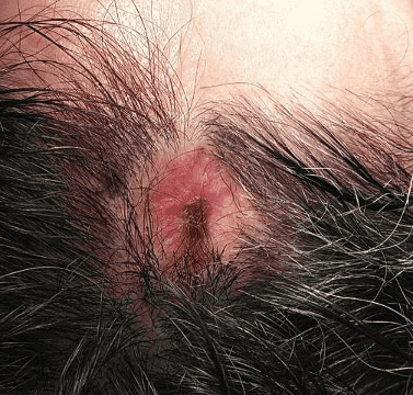 Close-up of scalp with inflamed bump