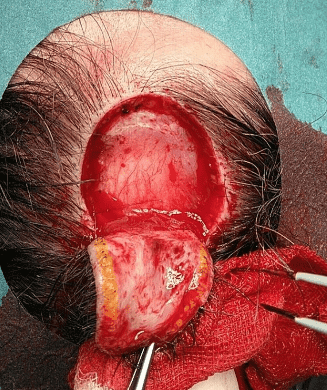 Surgical procedure on a scalp lesion