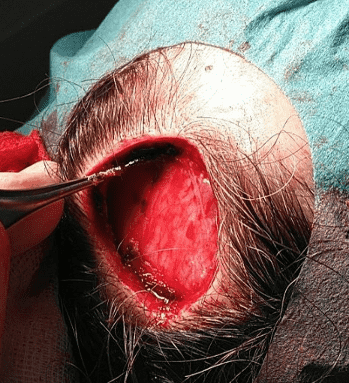 Surgical incision on a person's scalp